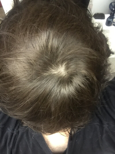 A cowlick, not a bald spot